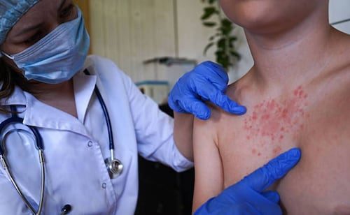EU reporta sus primeras muertes por sarampión en 35 años; fallecimientos ocurren en Pensilvania