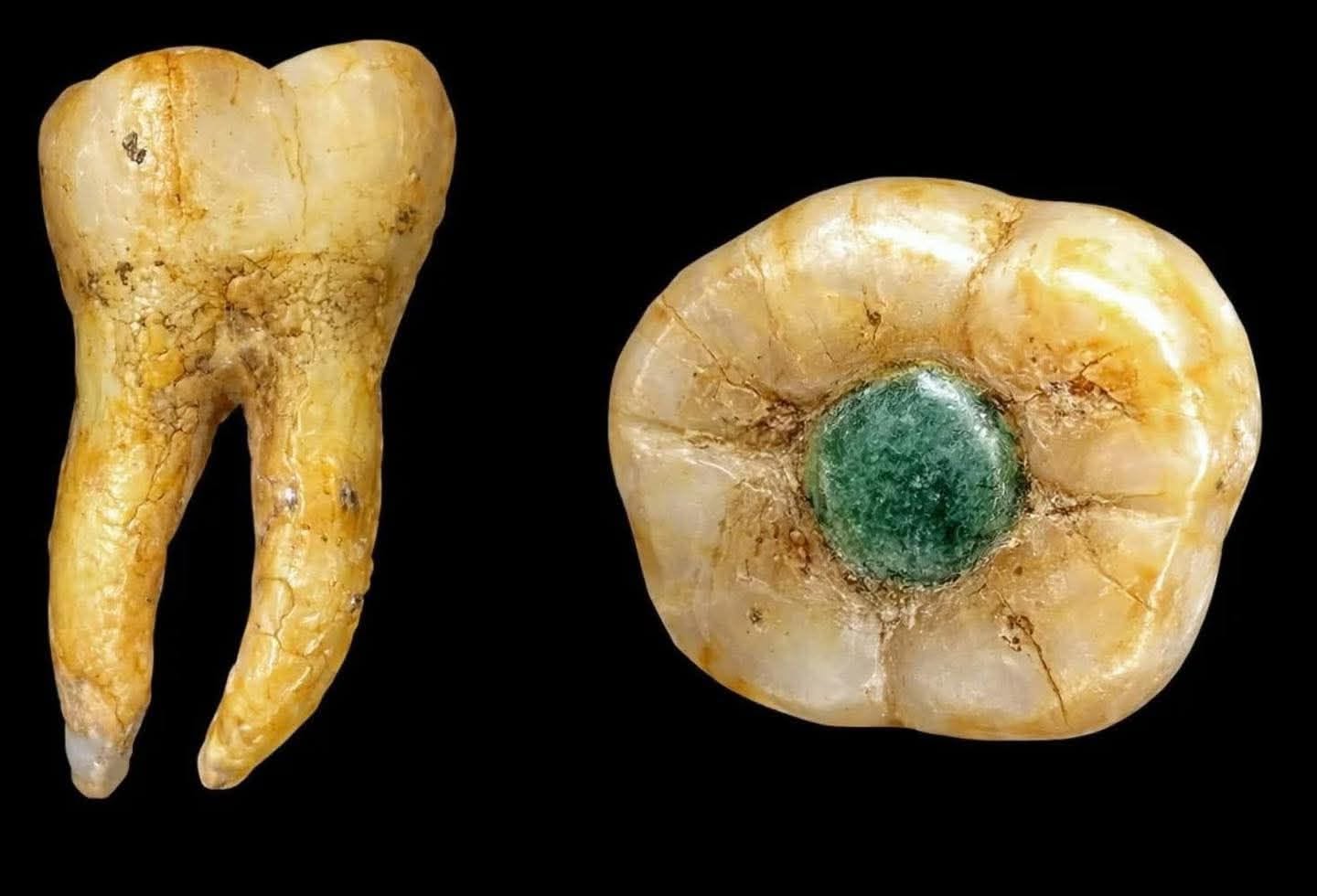 Incrustaciones de jade en los dientes: la avanzada odontología de los antiguos mayas