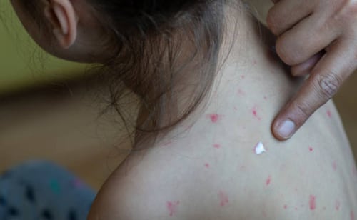 Pennsylvania reporta la tercera muerte por sarampión del año; EU tiene cifra récord de contagios